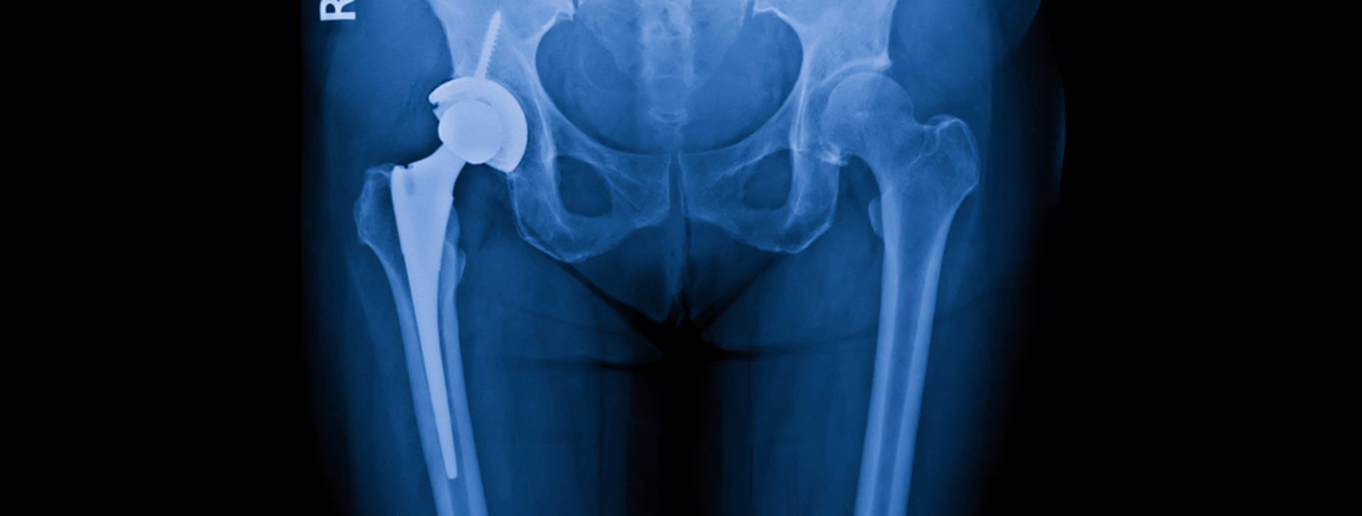 Ολική Αρθροπλαστική Ισχίου